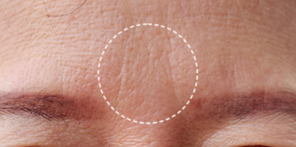 Close-up of skin with a wrinkle highlighted by a white circle.