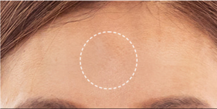 Close-up of a person's forehead with a white circle highlighting a specific area.