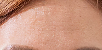 Close-up of a person's forehead with skin texture