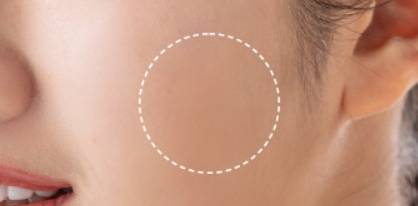 Close-up of a person's face with a dotted line circle on the cheek