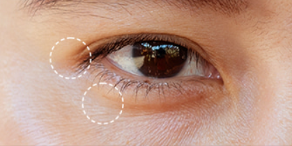 Close-up of a person's eye with a focus on the eyelid area.